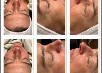 HYDRO-DERMABRASION  C'est le soin qui vous fait une peau neuve.